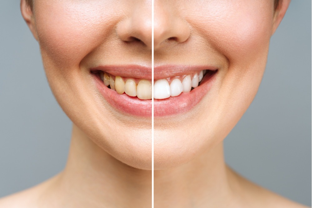 woman-teeth-before-after-whitening-white-background-dental-clinic-patient-image-symbolizes