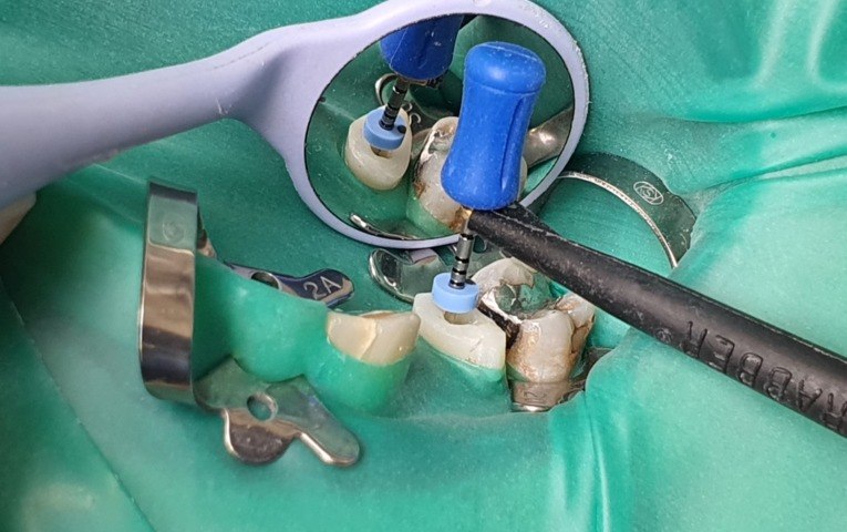 Mikroskopická endodoncia