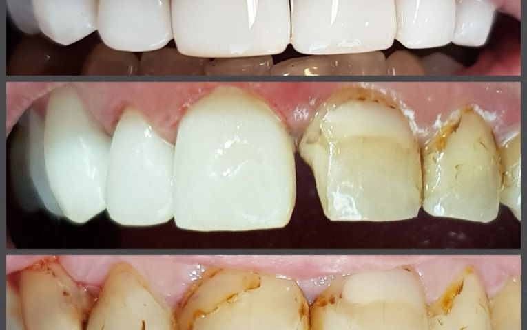 Fotokompozitné fazety a bielenie zubov